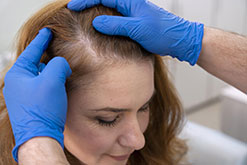 female-pattern-baldness