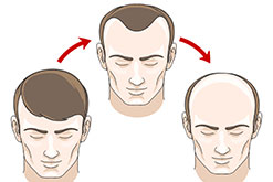 male-pattern-baldness