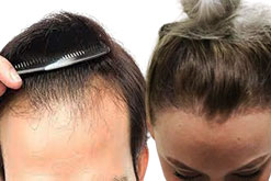 traction-alopecia