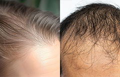 male and female hair loss problems